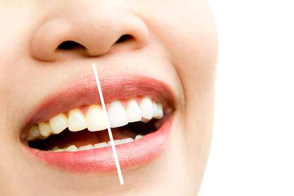blanqueamiento-dental-elche-clinica-dental-gustavo-garcia-del-rio blanqueamiento-dental-elche-clinica-dental-gustavo-garcia-del-rio