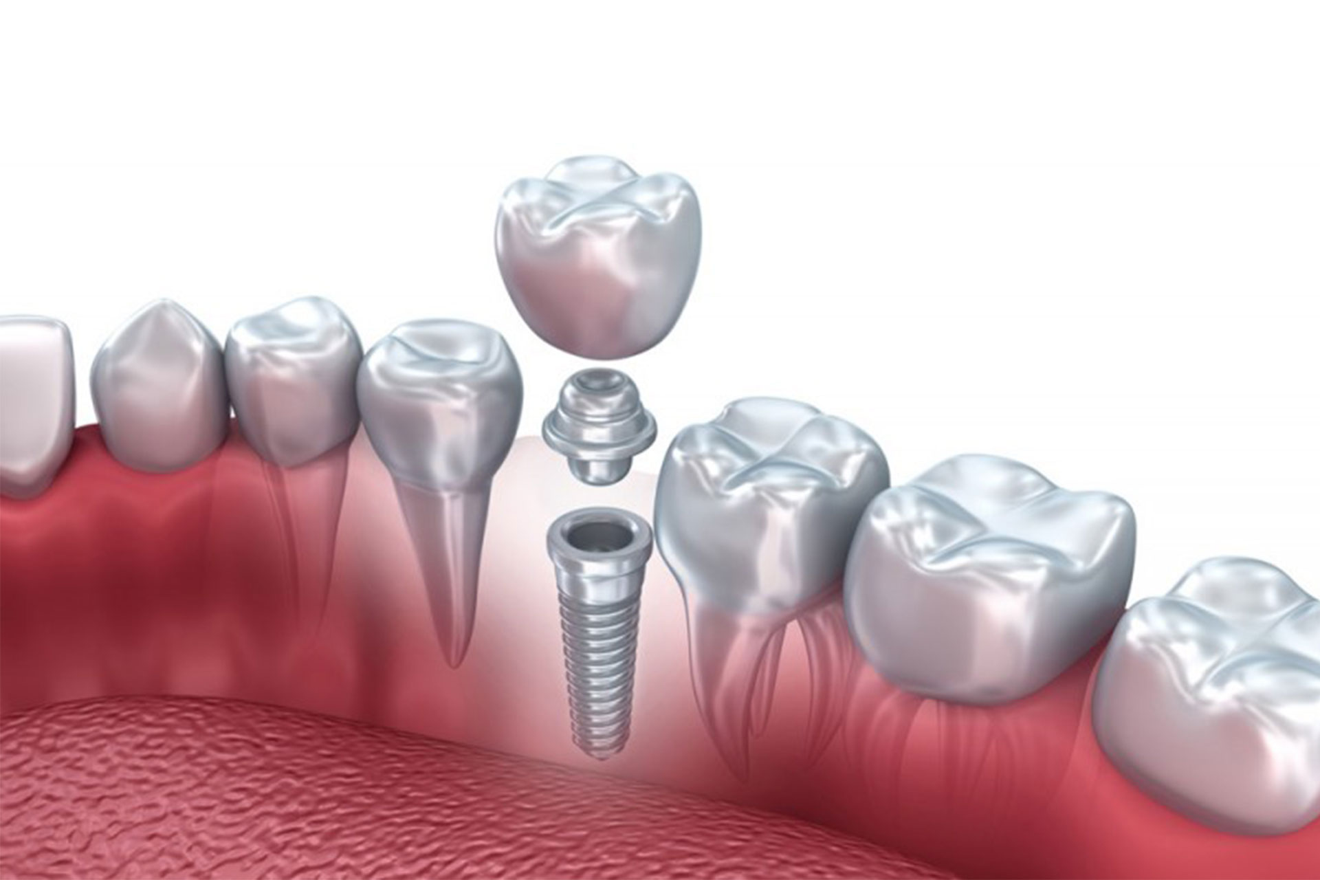 Implantes dentales Elche - Gustavo Garcia del Rio