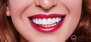 Carillas dentales, dudas resueltas