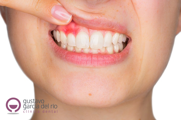 periodontitis